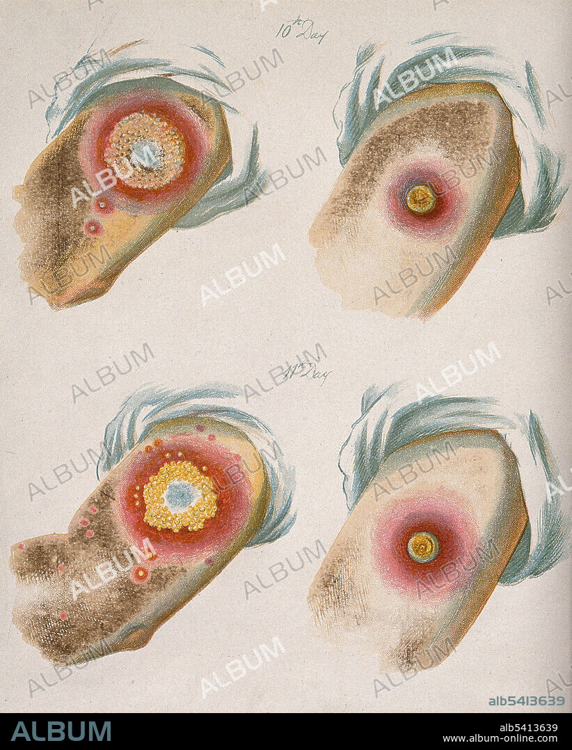 A comparison between smallpox and cowpox pustules on the 10 and 11th day of the disease. Cowpox (orthopoxvirus family) is an infectious disease caused by the cowpox virus. The virus is zoonotic, meaning that it is transferable between species, such as from animal to human. The transferral of the disease was first observed in dairymaids who touched the udders of infected cows and consequently developed the signature pustules on their hands. Cowpox is similar to, but much milder than, the highly contagious and often deadly smallpox disease. Its close resemblance to the mild form of smallpox and the observation that dairy farmers were immune from smallpox inspired the first smallpox vaccine, created and administered by English physician Edward Jenner. Once vaccinated, a patient develops antibodies that make them immune to cowpox, but they also develop immunity to the smallpox virus, or Variola virus. Chromolithograph, after George Kirtland, 1896.