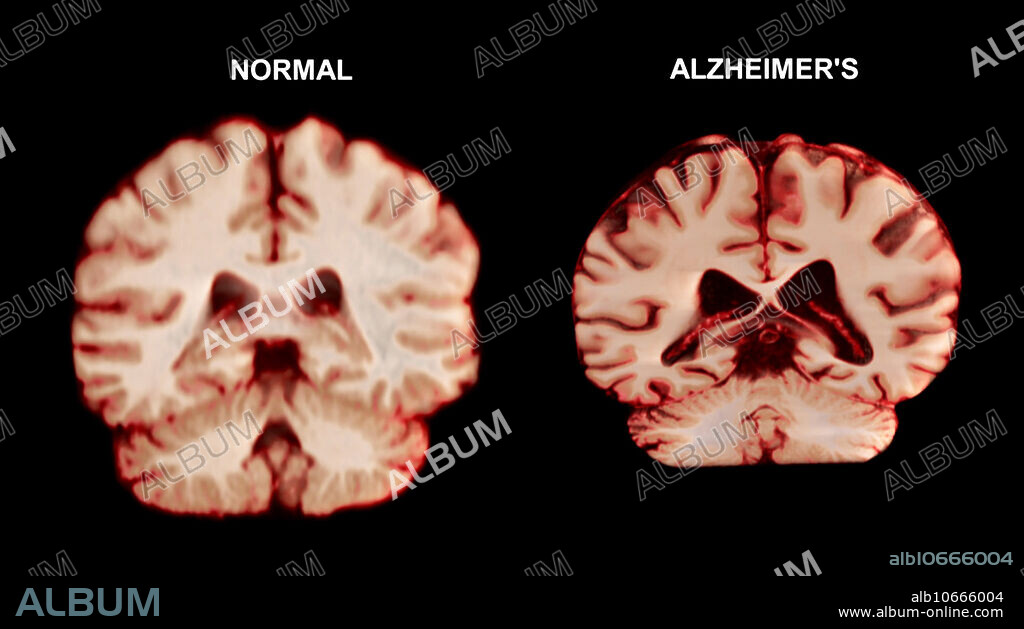 Visualization comparing a normal brain and a brain affected by Alzheimer's disease. The brain affected by Alzheimer's is considerably shrunken, due to the degeneration and death of nerve cells. Apart from a decrease in brain volume, the surface of the brain is often more deeply folded. Tangled protein filaments (neurofibrillary tangles) occur within nerve cells, and patients also develop brain lesions of beta-amyloid protein. Alzheimer's disease accounts for most cases of senile dementia. Symptoms include memory loss, disorientation, personality change and delusion.