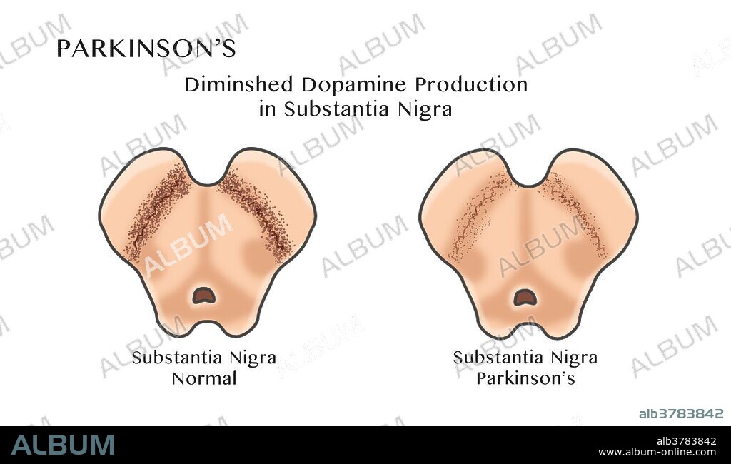 Illustration showing degeneration of dopaminergic neurons in the substantia nigra of the midbrain. At left is a normal substantia nigra at right is a diminished substantia nigra. Degeneration of this structure is characteristic of Parkinson's disease.