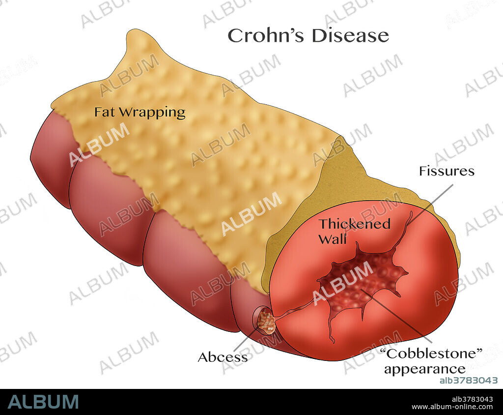 Crohn's Disease in section of large intestine, Illustration.