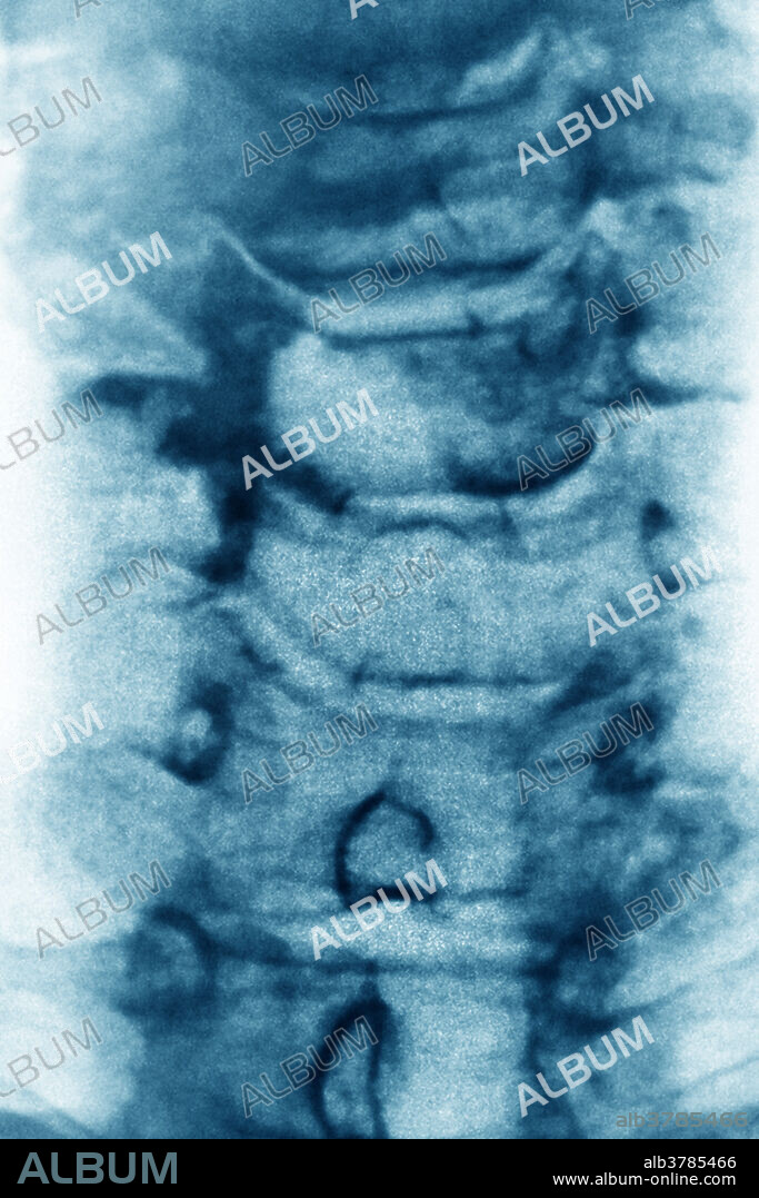 X-ray of the spine showing cervical spondylosis.