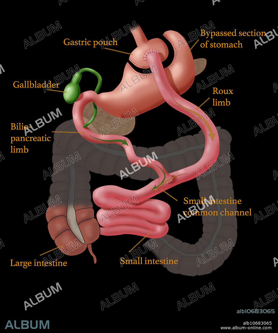 Roux-en-Y (RNY) gastric bypass is a weight loss surgery, or bariatric surgery, that is performed on patients who have tried and failed to lose weight losing using traditional methods. In Roux-en-Y gastric bypass, a small pouch at the top of the stomach is the only part of it that receives food, limiting intake. The small intestine is cut a short distance below the main stomach and connected to the new pouch. Food flows directly from the pouch into this part of the intestine. Because food now bypasses a portion of the small intestine, fewer calories are absorbed.