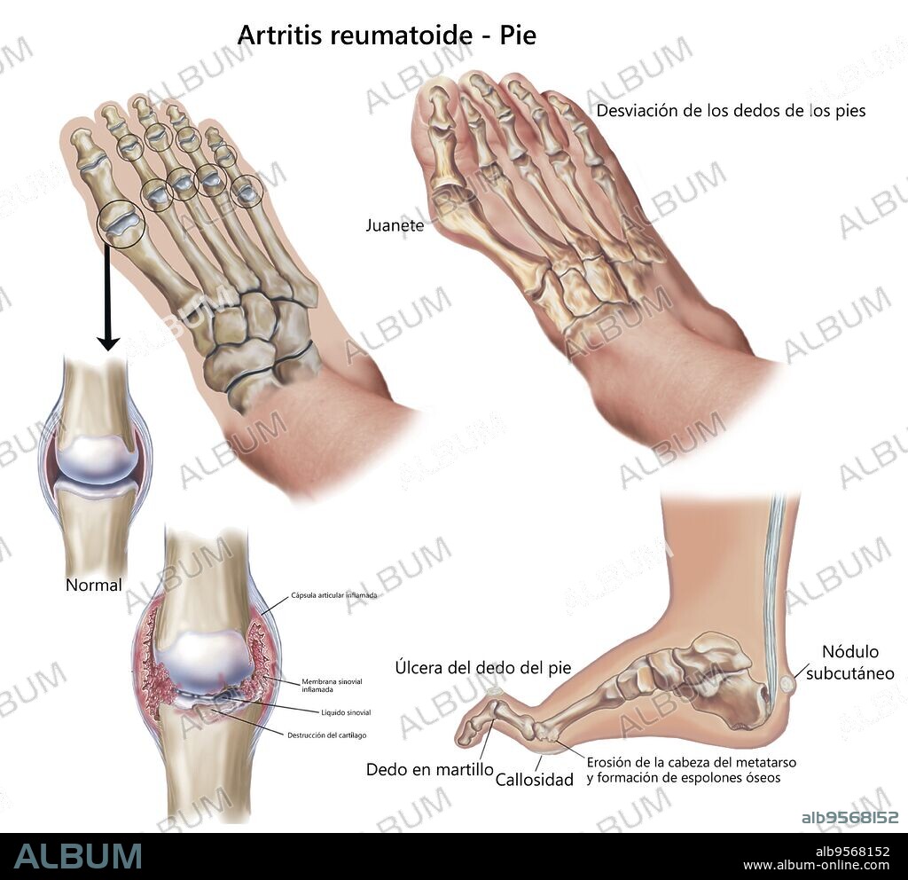 Top and side view of foot showing deformities caused by rheumatoid arthritis.