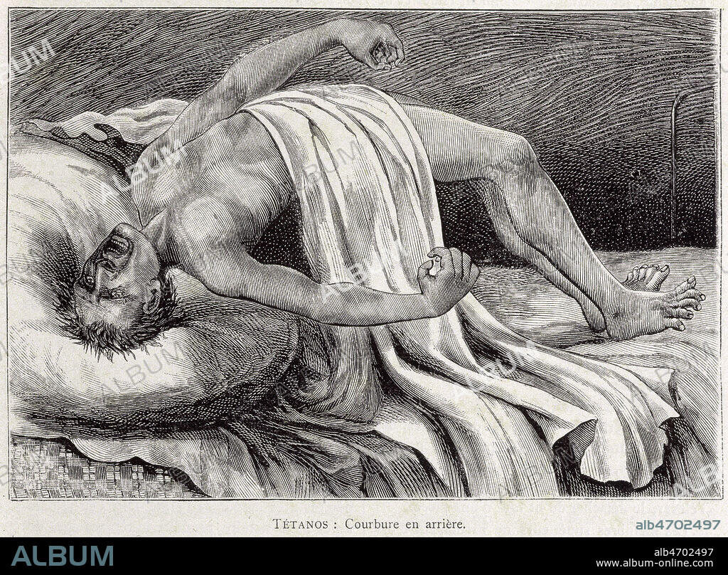 Tetanos. Courbure en arriere. Illustration anonyme pour La Medecine illustree de 1888. Credit : Collection KHARBINE-TAPABOR.