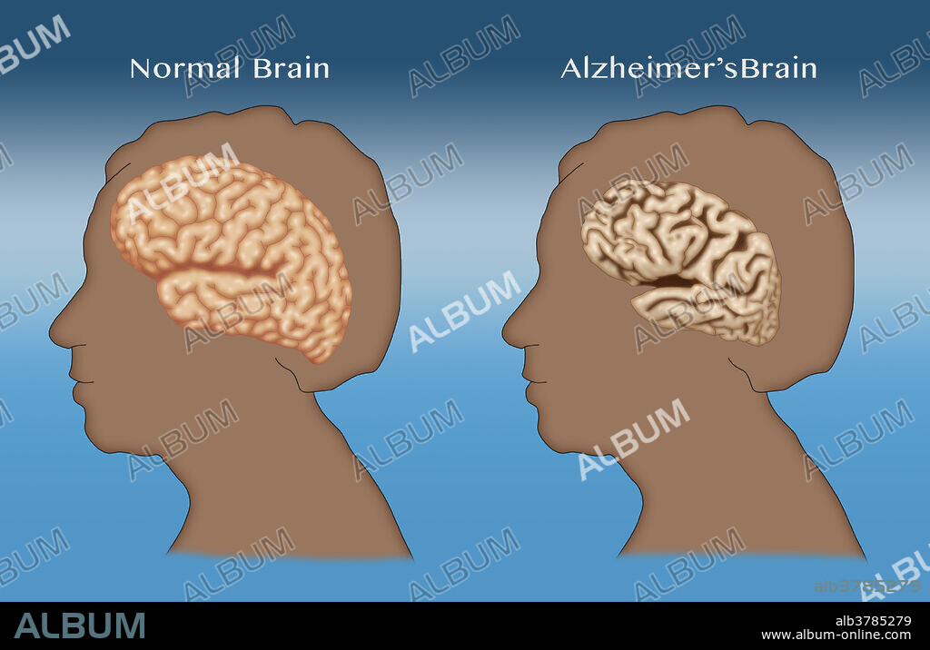 Illustration comparing a normal brain (left) with a brain suffering from Alzheimer's disease (right).