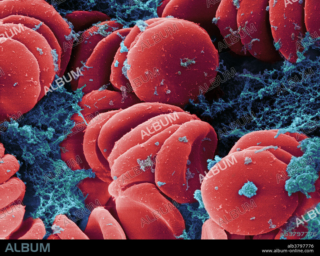 Coloured scanning electron micrograph (SEM) of clotting red blood cells from an 18-year-old male's wisdom tooth tissue. The red blood cells are starting to clot in this image. Magnification: x5100 when printed 10cm wide.