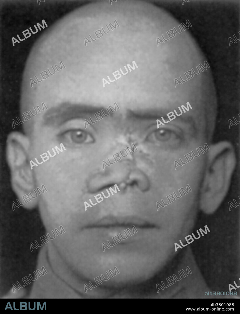 First World War veteran requiring reconstructive nose surgery.  The surgeons frequently used bone fragments and skin flaps from the patient's brow for the operations.