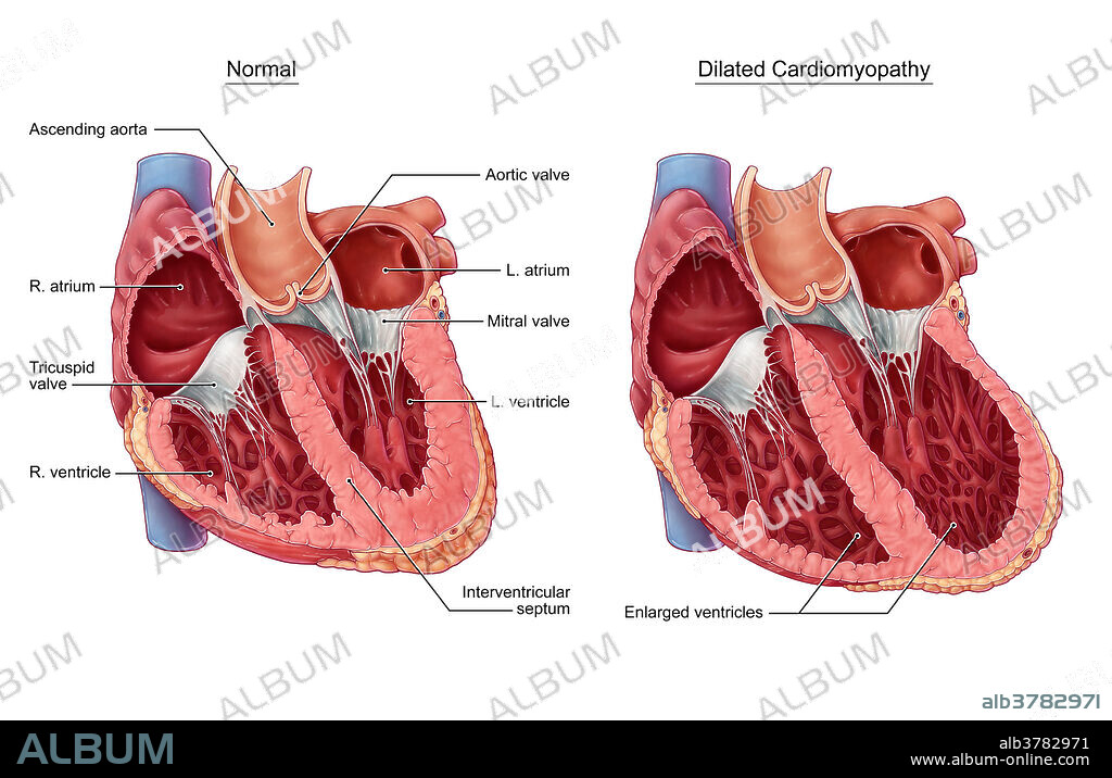 A comparative illustration of a normal heart and a heart affected by dilated cardiomyopathy. Dilated cardiomyopathy is the most common type of cardiomyopathy often caused by coronary heart disease, diabetes, alcohol abuse, viral infections, thyroid disease, or genetics. The walls of the ventricles stretch and thin (dilate), creating an enlarged heart. This inhibits the heart's ability to pump enough blood throughout the body and may also result in abnormal heart beats (arrhythmia).