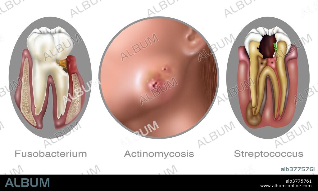 Illustration of oral Infections caused by bacteria. Fusobacterium nucleatum, is an oral bacteria found in the dental plaque of humans. Associated with the periodontal gum disease. Actinomycosis. This Bacterial infection begins in the spaces between the teeth and gums and penetrates the surrounding muscle bone and skin of the face. Streptococcus oralis bacteria is found in the cavity of a human tooth. Streptococcus oralis is a type (genus) of spherical bacteria, that can colonize the throat and back of the mouth.