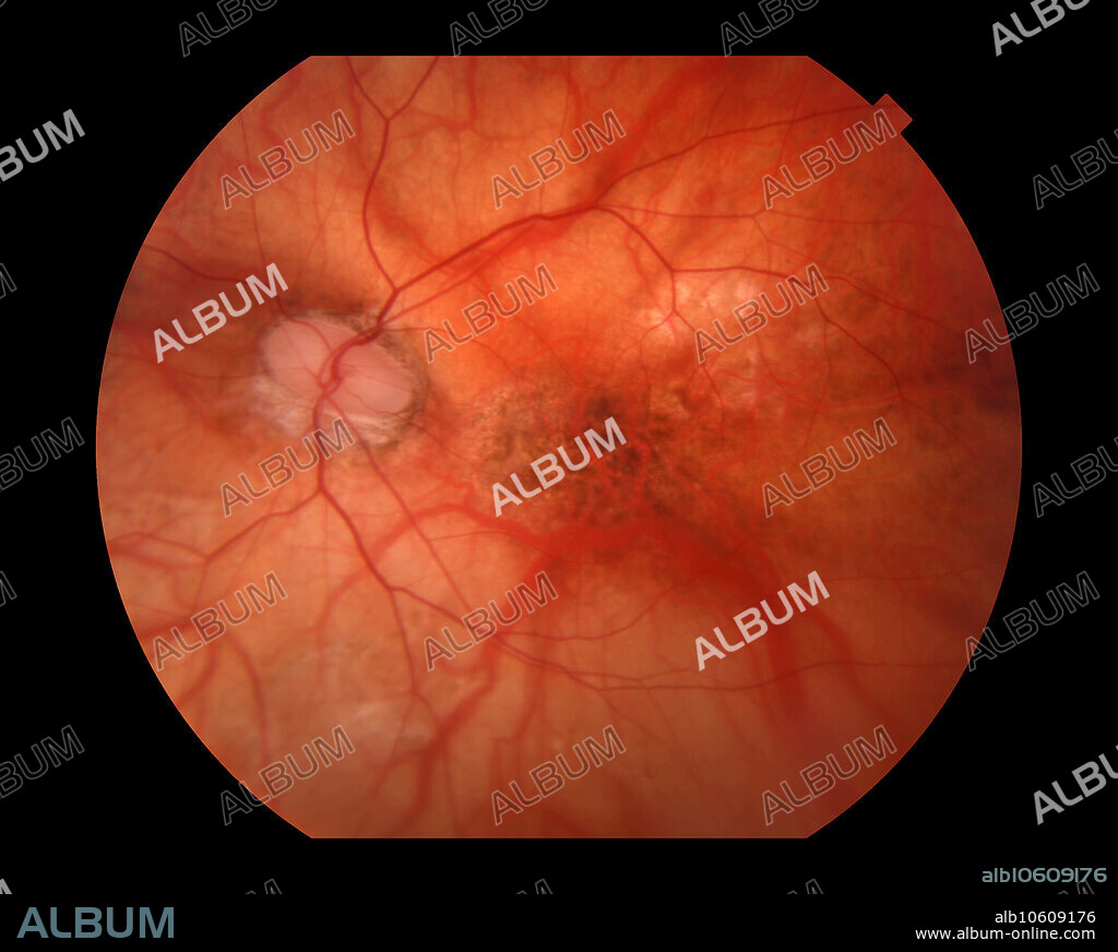 A person with myopia is someone who is shortsighted or nearsighted. This is because the focal point of the light entering the eye falls in front of the retina instead of on it. This most often is because the eye is optically too powerful for its axial length or too long for its optical power. In the case of myopic degeneration there are progressive fundus changes that get worse over time.