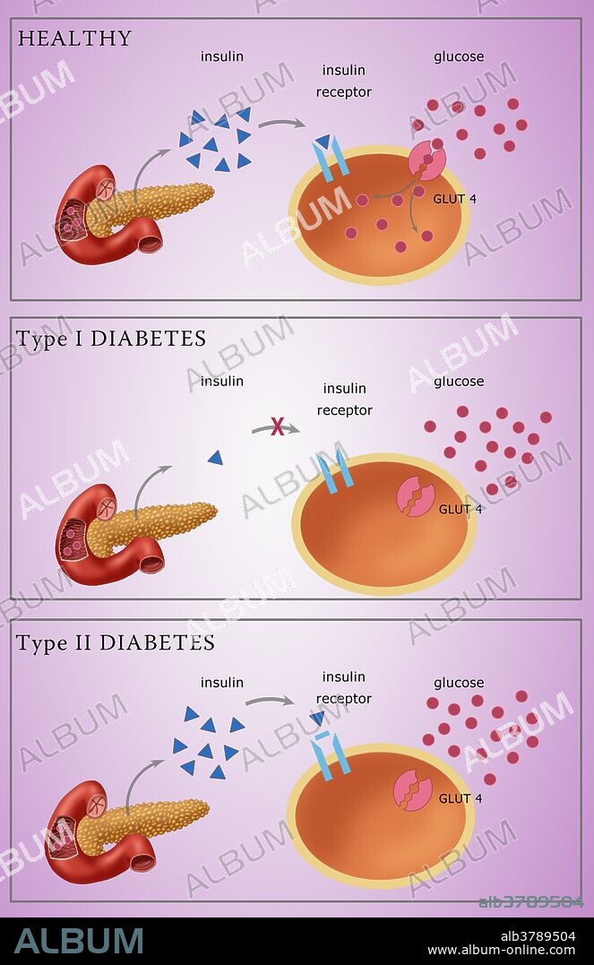 Comparative diagram of type I diabetes and type II diabetes, insulin, glucose, GLUT4 transporter protein, pancreas, medical illustration