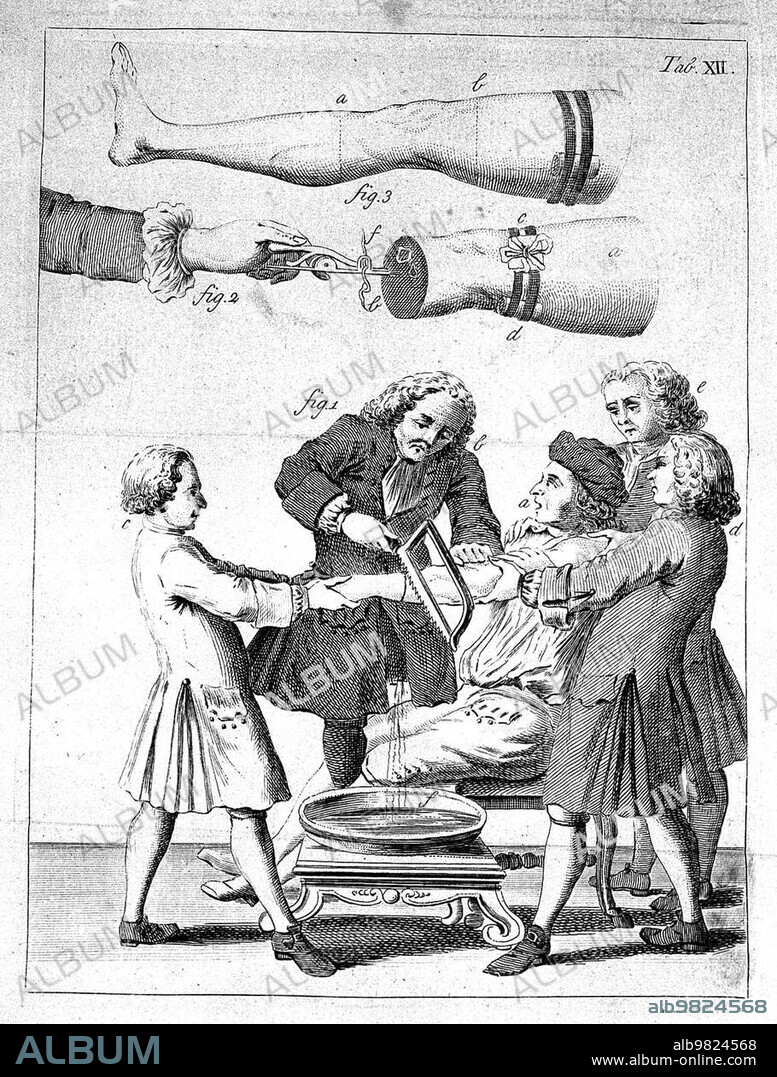 Medicine; Anatomy; Surgery; The Elements of Surgery; 1764; An amputation of the leg; Historical; digitally restored reproduction from a 19th century original.