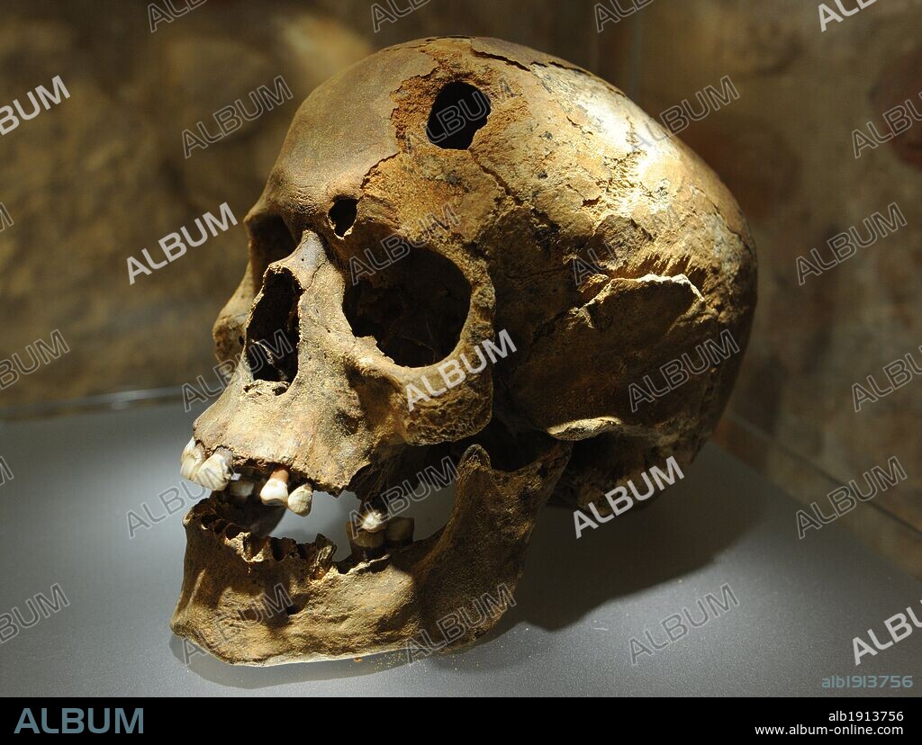 Poland. Krakow. Rynek Underground or the Underground Square Central Museum. Located below of the Market Square. Medieval archaeological remains of the commercial area of the city, 4 meters below the square. A cementery was also found. Human skull with trepanation. Age 40 years. 11th century. It is believed that the type of trepanation was therapeutic because of the scarring of the bone, and that the patient lived several weeks after the operation.