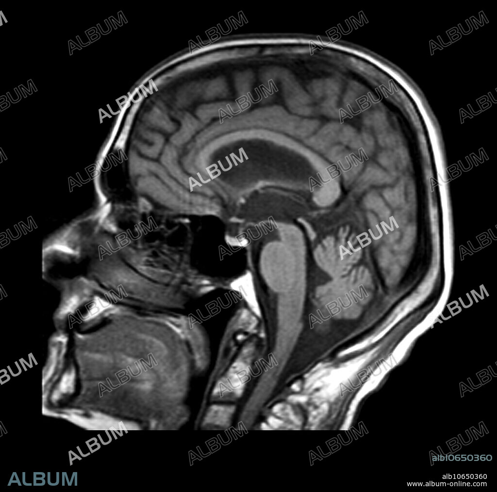 Normal Pressure Hydrocephalus - Album alb10650360