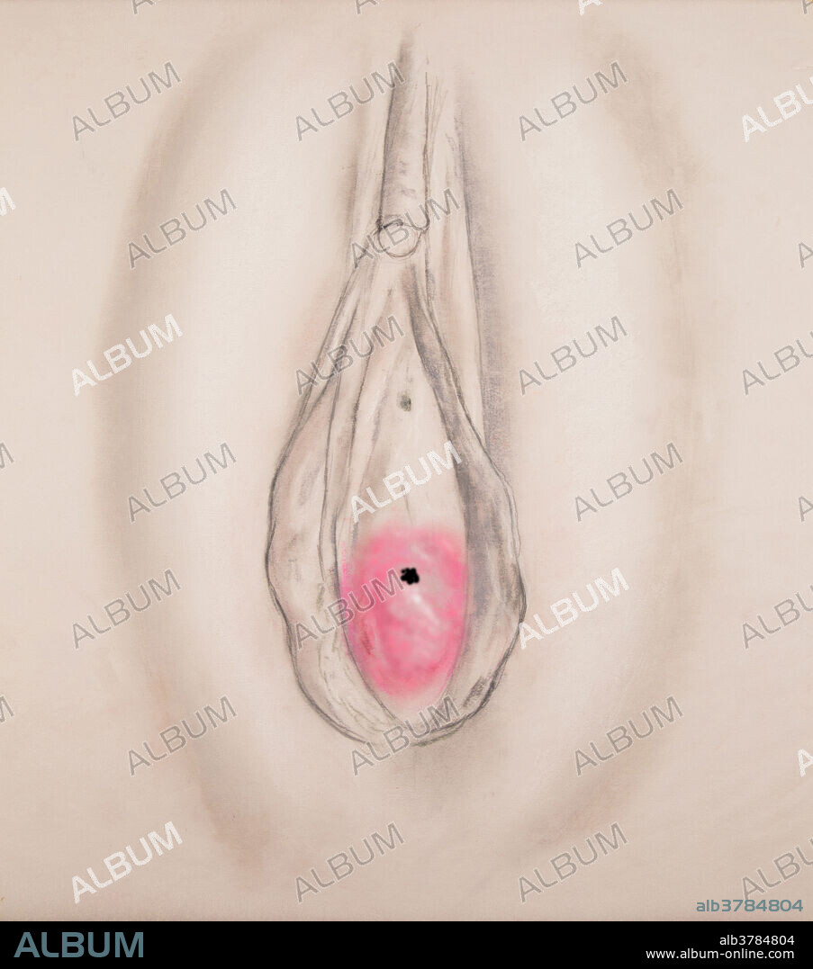 The opening in a microperforate hymen is usually large enough for the menstrual flow to escape but minor surgery is often required to allow for the insertion of tampons or for sexual intercourse.