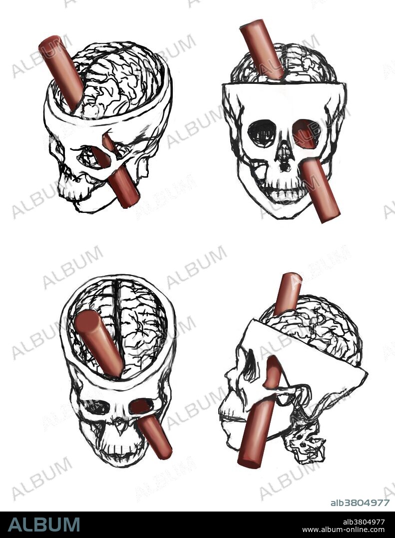 An illustration of the Brain injury of Phineas Gage. Phineas P. Gage, 1823-1860, was an American railroad worker that survived an accident in 1848 in which a large iron rod was driven through his head. The iron rod destroyed most of his left frontal lobe. The effects of the injury on his personality has been much debated as there is scant written evidence of what his behavior actually was for the twelve remaining years of his life.