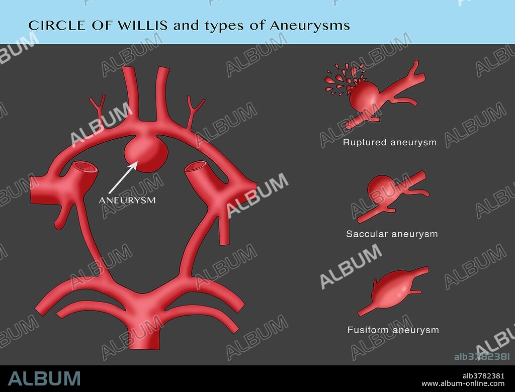 Aneurysm in the Circle of Willis, showing possible types (ruptured, fusiform, and saccular) at right. The circle of Willis (also called Willis' circle, loop of Willis, cerebral arterial circle, and Willis polygon) is a circulatory anastomosis that supplies blood to the brain and surrounding structures. It is named after Thomas Willis (1621-1675), an English physician.