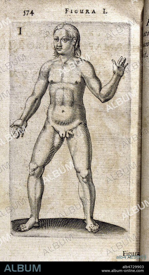 Hermaphrodite dote de deux sexes, masculin et feminin, places cote a cote au bas du ventre. Illustration tiree de l'ouvrage de Gaspard BAUHIN (1560-1624) 'De hermaphroditorum natura', publie en 1614 (17e, 17eme, XVIIe s.). Credit : JEAN VIGNE / KHARBINE-TAPABOR.