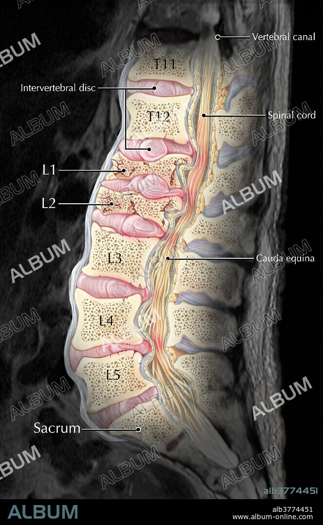 An interpretive illustration of an MRI depicting a sagittal view of compression fractures at the L1 and L2 vertebrae as a result of osteoporosis. Over time as bone becomes weaker and more porous, they become more susceptible to injury and fractures, especially in situations where significant weight or stress is placed on the bone. In this case, the vertebral bodies of L1 and L2 have collapsed, resulting in a displacement of the bones and intervertebral discs into the spinal canal, resulting in pain and possibly reducing the patient's mobility.