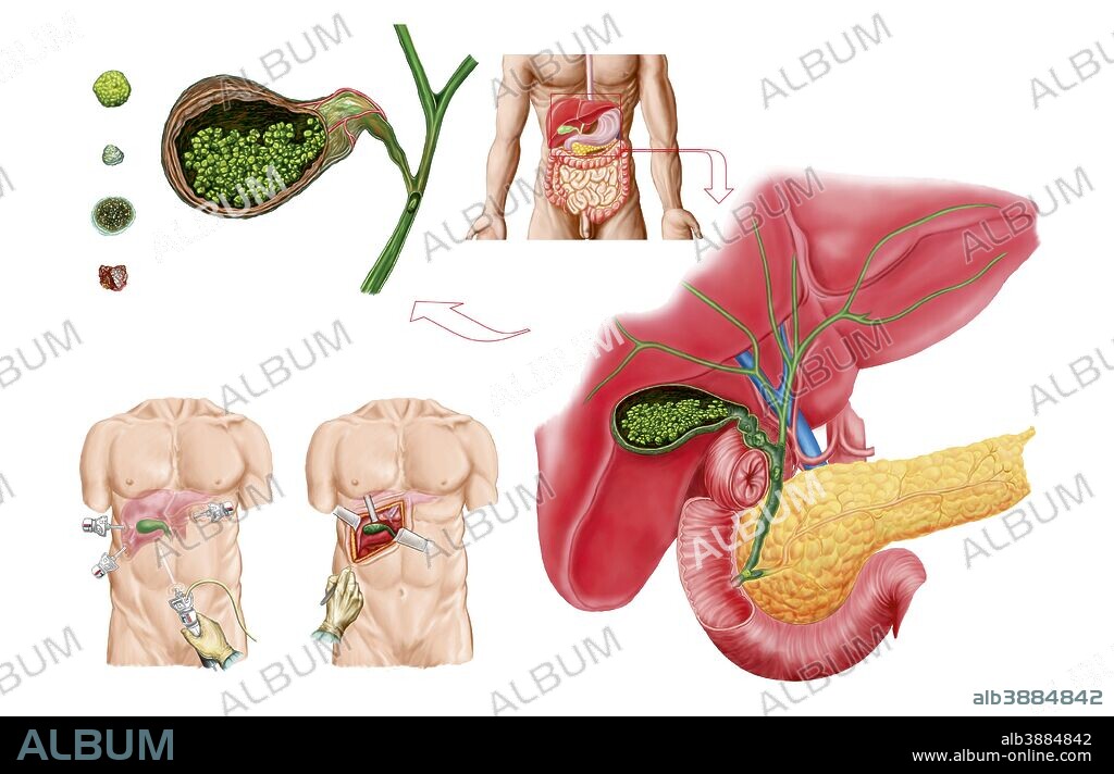 Medical ilustration showing gallstones in the gallbladder and the surgical removal of the gallbladder, known as cholecystectomy.