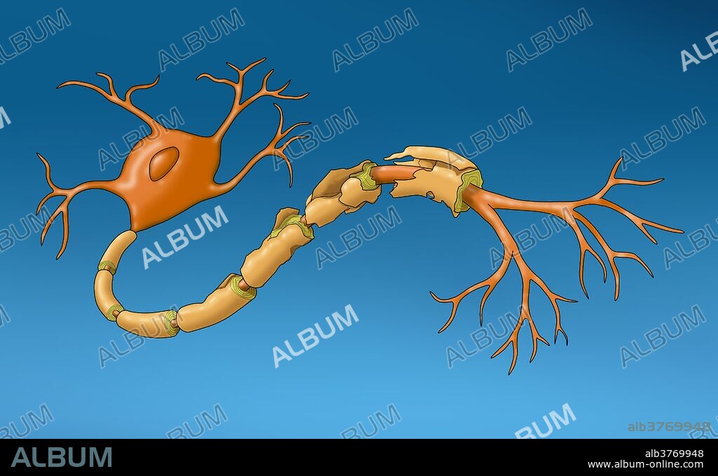 Demyelination. A demyelinating disease is any disease of the nervous system in which the myelin sheath of neurons is damaged.