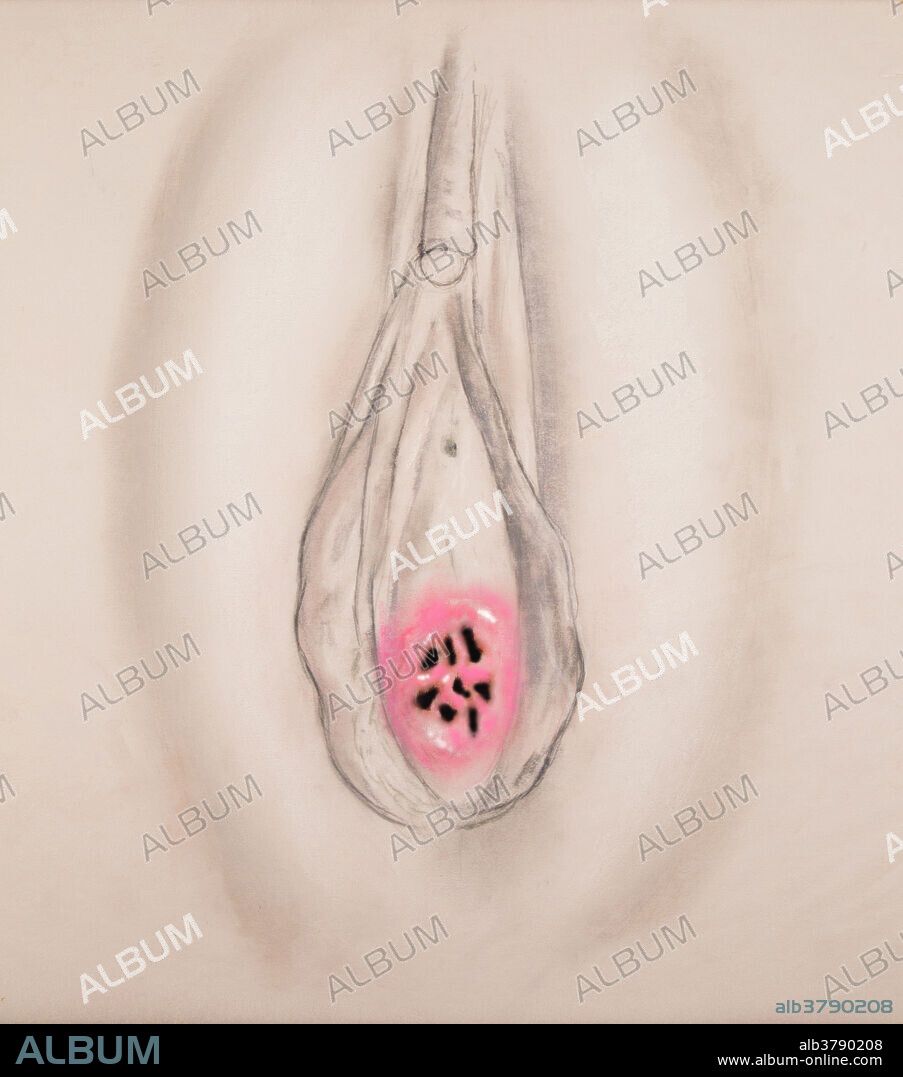 An example of a cribriform hymen in which the hymen has several small openings. The openings in a cribriform hymen are usually large enough for the menstrual flow to escape but minor surgery is often required to allow for the insertion of tampons or for sexual intercourse.