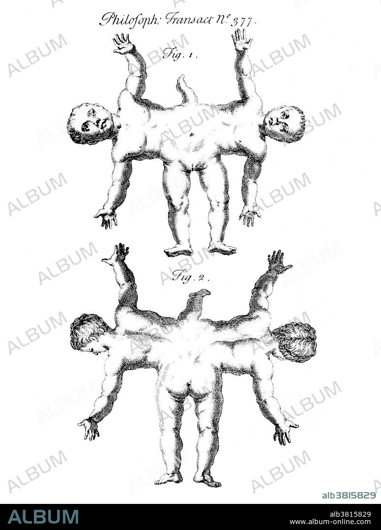 Conjoined twins are identical twins born with their bodies joined at some point and having varying degrees of residual duplication, a result of the incomplete division of the ovum from which the twins developed. Ischiopagus twins have fused lower half of the two bodies, with spines conjoined end-to-end at a 180 degree angle. These twins have four arms; two, three or four legs; and typically one external set of genitalia and anus. Image appeared in "Philosophical transactions", Volume 31-32 Number 377, Firgure 1 & 2, published 1720-23.