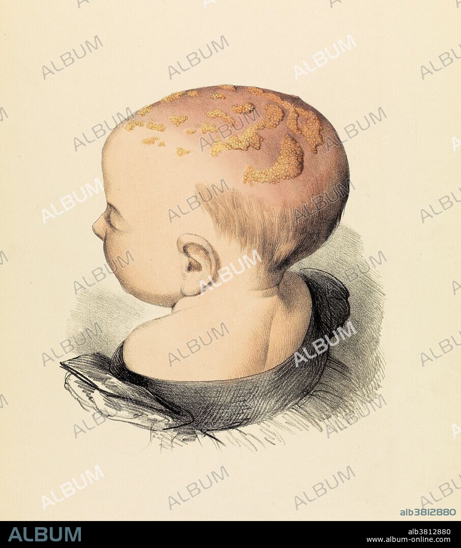 Impetigo Conferta Capilitii on top of infant's head, 1841. Impetigo is a bacterial infection that involves the superficial skin. The most common presentation is yellowish crust on the face, arms, or legs. Less commonly there may be large blisters which affect the groin or armpits. The lesions may be painful or itchy. It is typically due to either Staphylococcus aureus or Streptococcus pyogenes. Risk factors include attending daycare, crowding, poor nutrition, diabetes, contact sports, and breaks in the skin such as from mosquito bites, eczema, or scabies. Robert Willis.