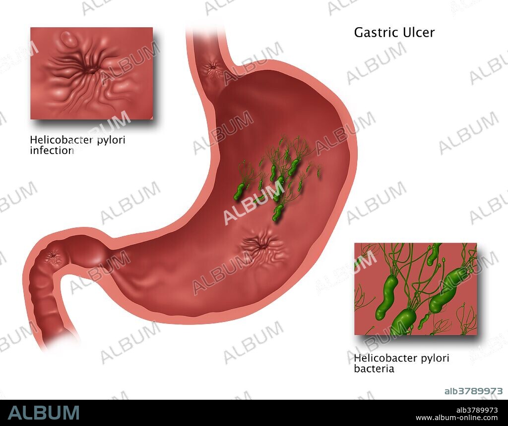 Illustration showing the stomach with a gastric ulcer caused by Helicobacter pylori. H. Pylori is the most common cause of stomach ulcers.
