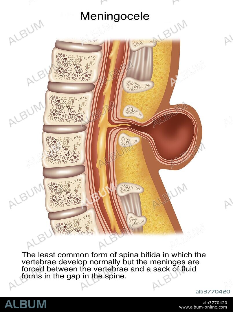 Illustration of spina meningocele. Spina meningocele is the least common form of spina bifida in which the vertebrae develop normally but the meninges are forced between the verebrae and a sack of fluid forms in the gap in the spine.