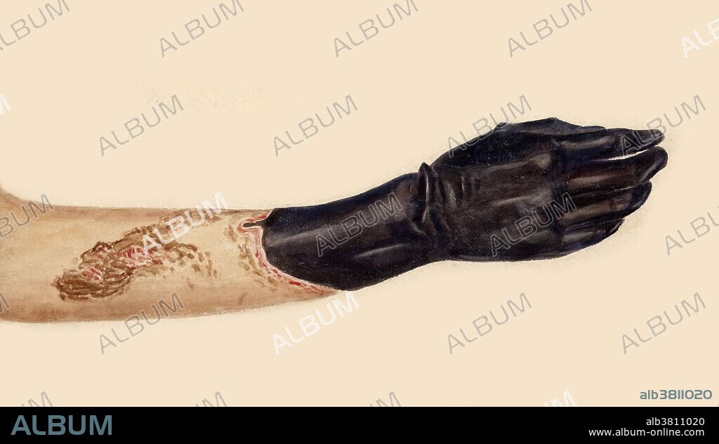 Watercolor drawing of the right hand and forearm of a woman, aged 32 years, in a condition of dry gangrene. The skin of the whole hand, and that over the lower half of the forearm, is of a uniform black. There is a well-defined line of demarcation where the edges of the healthy skin are red and ulcerated. There is also a patch of superficial ulceration on the upper part of the forearm. Leonard Mark, 1893.
