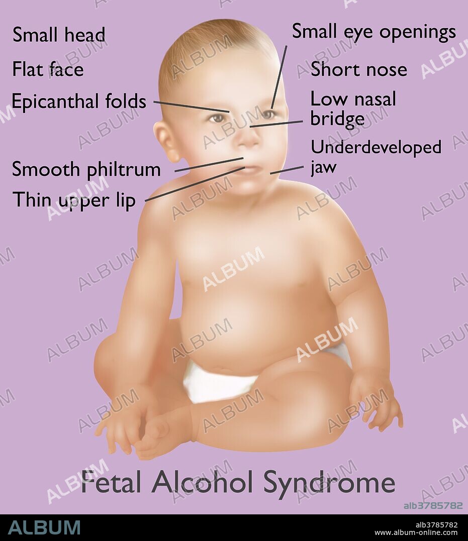 Illustration of baby with Fetal Alcohol Syndrome. Fetal Alcohol Syndrome or (FAS) is a condition in infants that is caused by alcohol consumption by the mother during time of pregnancy. Mental and physical defects such as a small head, flat face, epicanthal folds, smooth philtrum, thin upper lip, small eye openings, short nose, low nasal bridge, and underdeveloped jaw, are common symptoms of fetal exposure to alcohol.