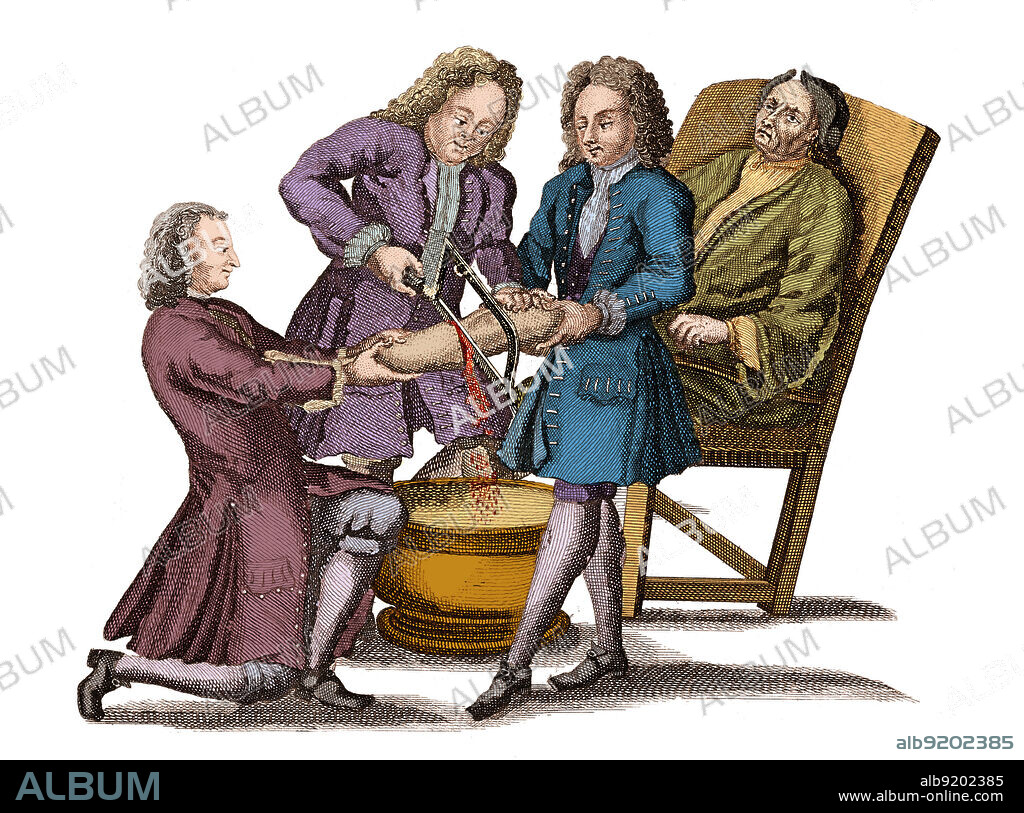 Amputation, Lorenz Heister, 1718. Lorenz Heister (1683-1758) was a German anatomist, surgeon and botanist whose best-known work is Chirurgie, a book on surgery originally published in 1718, from which this 1739 illustration derives. He coined the word "tracheotomy." He is credited with being the first physician to perform a post-mortem section of appendicitis. Colorized.