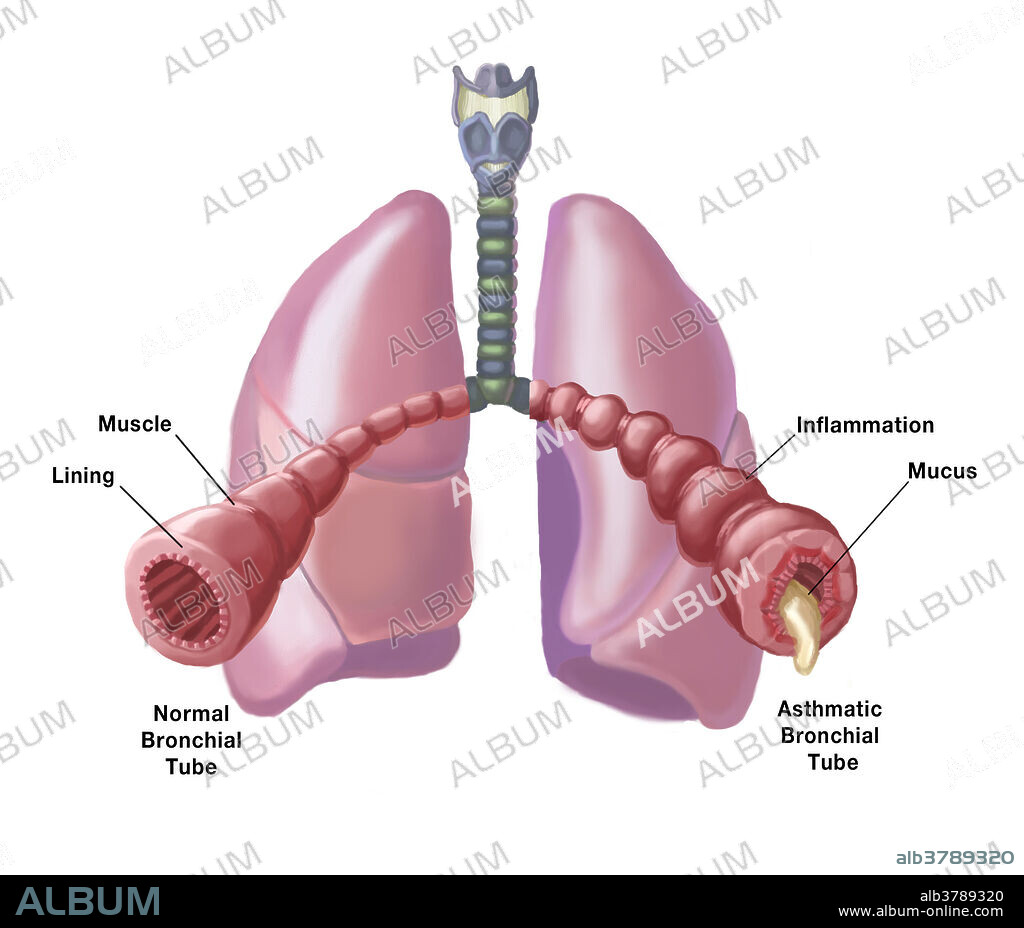 Illustration of the bronchial tubes of the lungs, comparing the appearance of a normal, healthy bronchial tube (left) to one in a person with asthma (right), in which case the bronchial tube becomes inflamed and clogged with mucus.