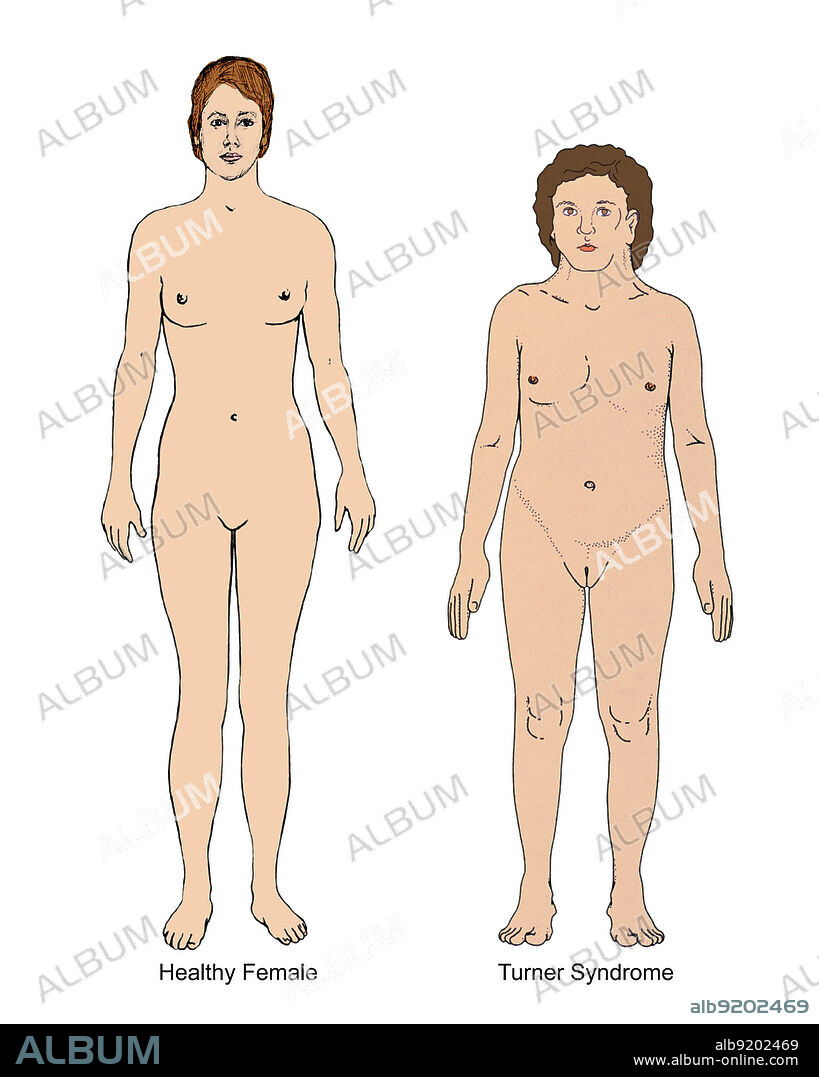 Turner Syndrome & Healthy Female