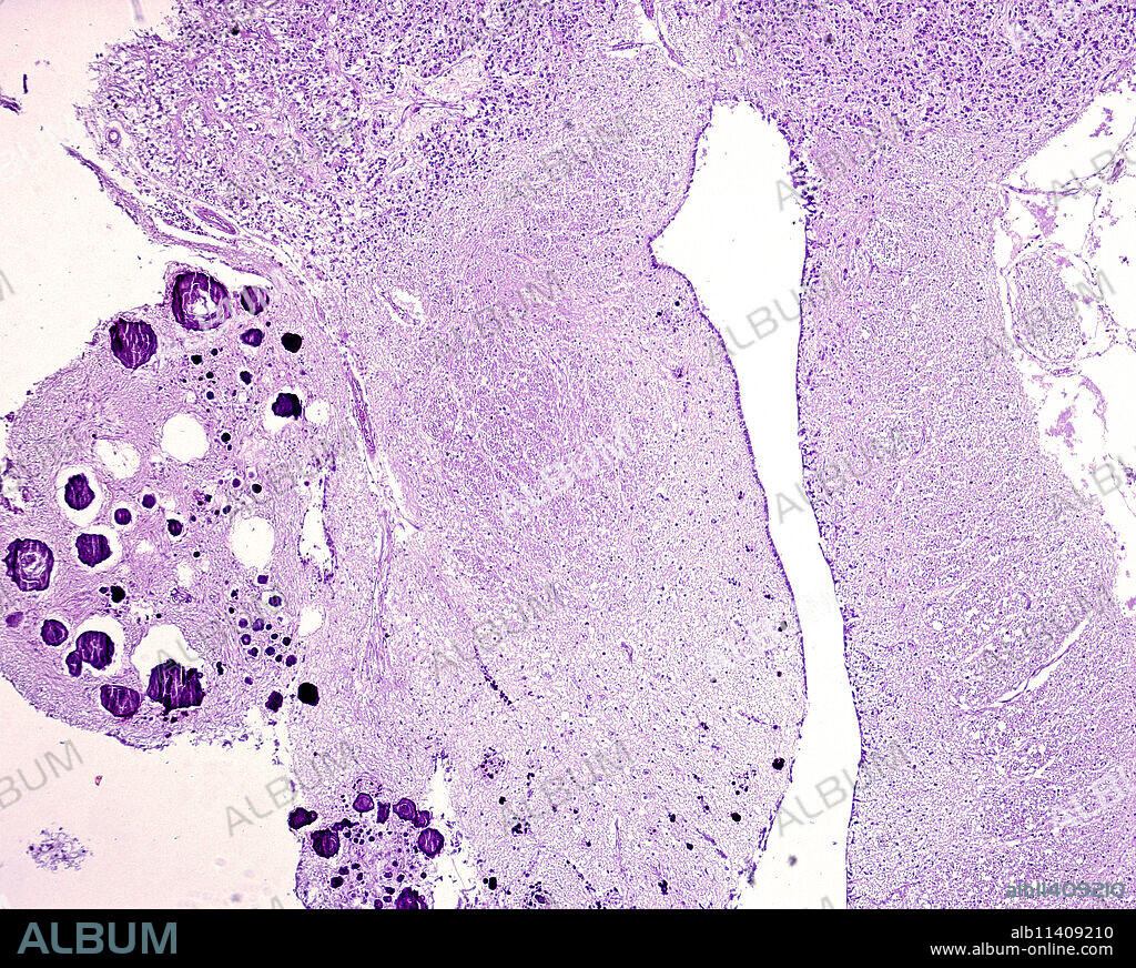 Habenular Commissure, Calcium Concretions, light micrograph