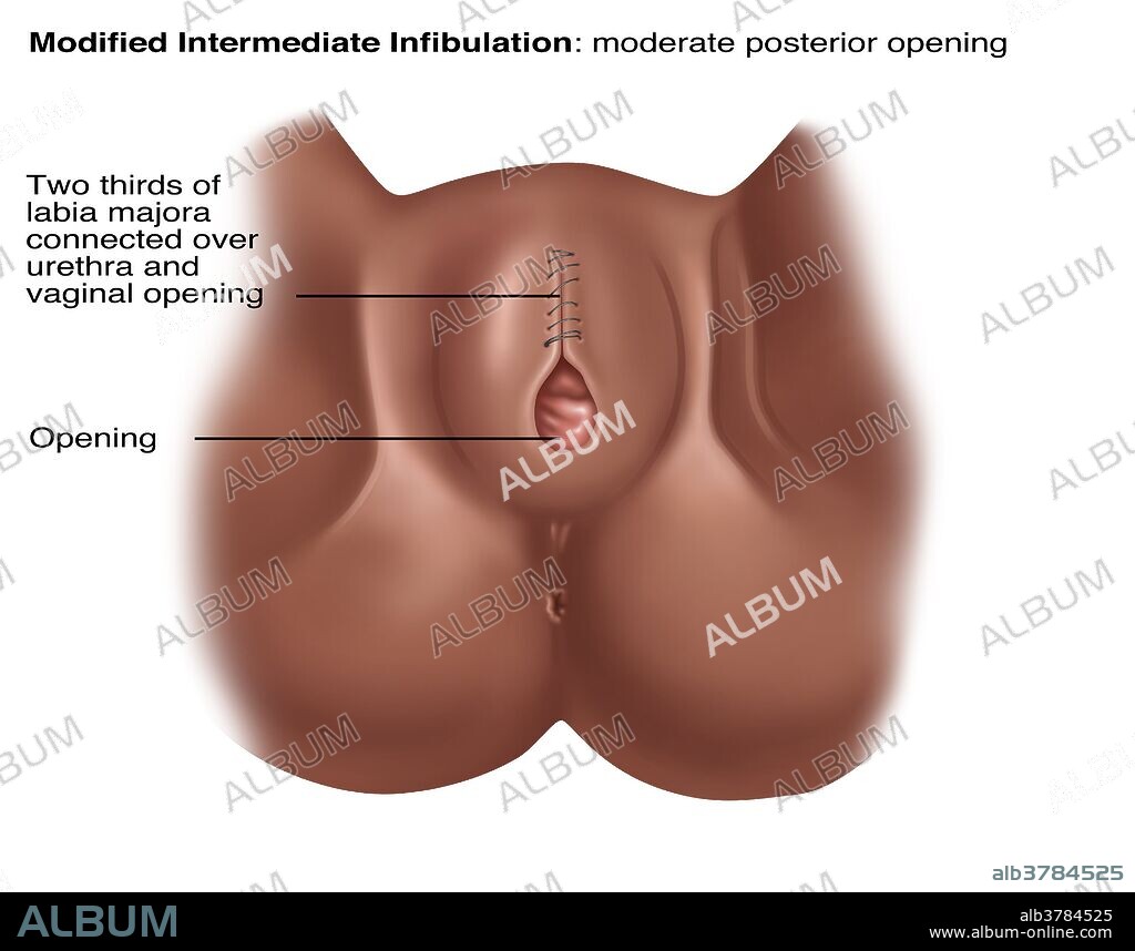 Modified Infibulation, Illustration - Album alb3784525