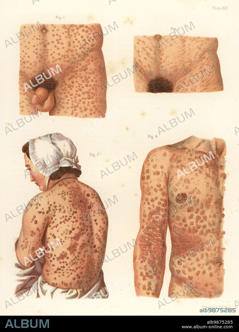 Diffused papular syphillde before treatment 1, same after treatment with mercury 2, papular syphilide with scales on back 3, and syphilitic lichen on sides and arms 4. Chromolithograph by T. Sinclaire from Freeman J. Bumsteads Atlas of Venereal Diseases, Henry C. Lea, Philadelphia, 1868. First American edition of Auguste Culleriers Precis iconographique des maladies veneriennes.