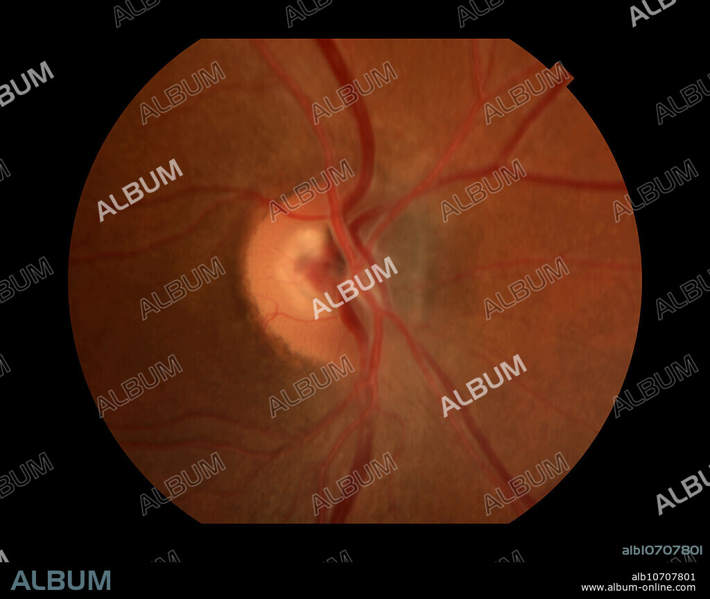 Malignant choroidal melanoma of the optic nerve.