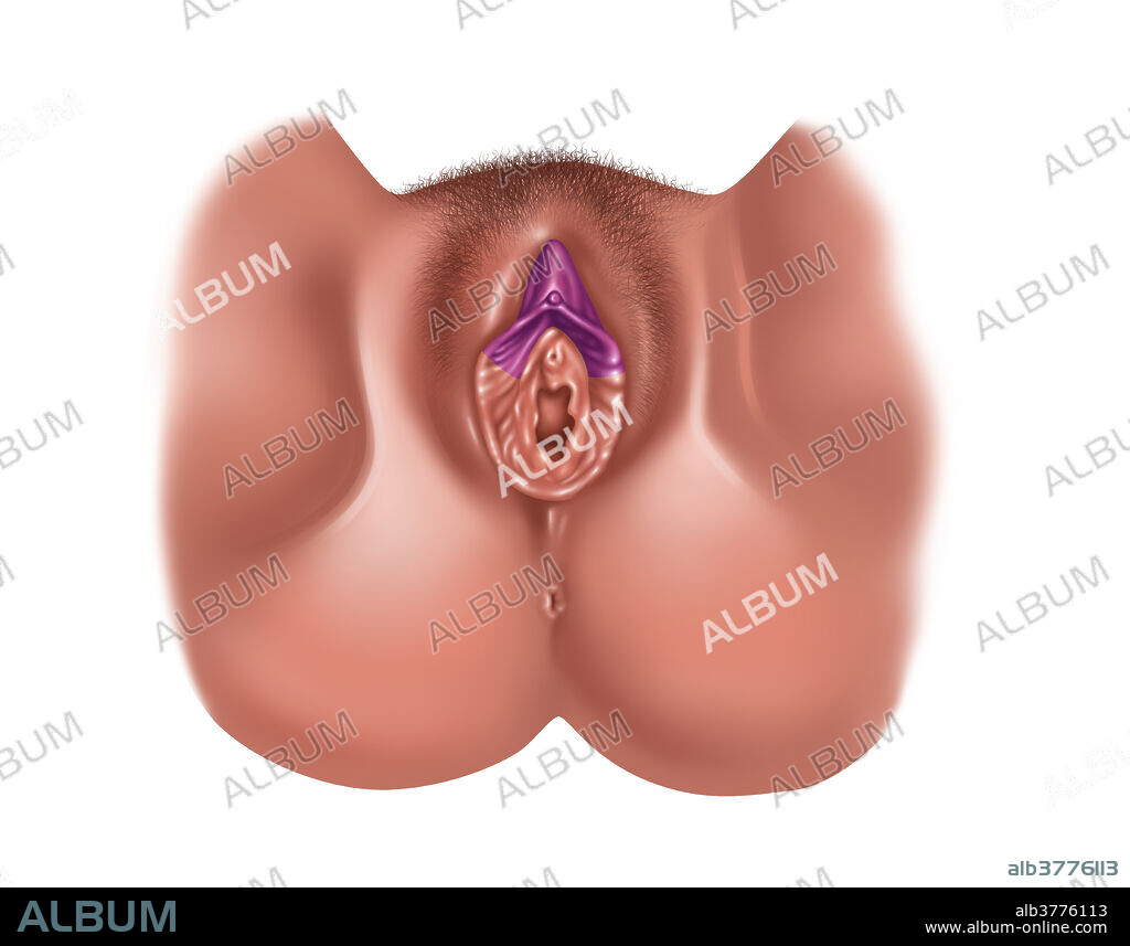 Clitoridectomy & Partial Labia Excision