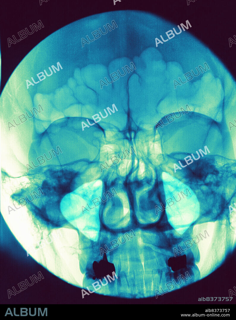 Sinus of the face. Incidence of Blondeau. Normal maxillary and frontal sinuses.