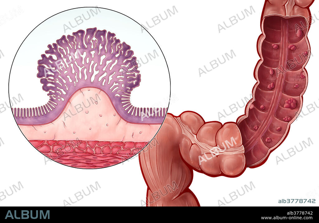An illustration of colorectal polyps, abnormal growths of tissue projecting from the mucous membrane in the colon. A growth that lacks a narrow elongated stalk is classified as sessile Although polyps usually don't present any symptoms, untreated colon polyps can eventually develop into colon cancer.