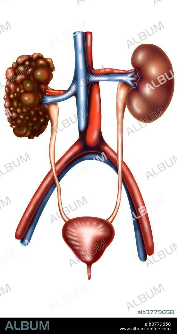 Polycystic kidney disease (PKD or PCKD, also known as polycystic kidney syndrome) is a cystic genetic disorder of the kidneys. There are two types of PKD: autosomal dominant polycystic kidney disease and the less-common autosomal recessive polycystic kidney disease. PKD is characterized by the presence of multiple cysts. The cysts are numerous and are fluid-filled, resulting in massive enlargement of the kidneys. The disease can also damage the liver, pancreas and, in some rare cases, the heart and brain. The two major forms of polycystic kidney disease are distinguished by their patterns of inheritance.