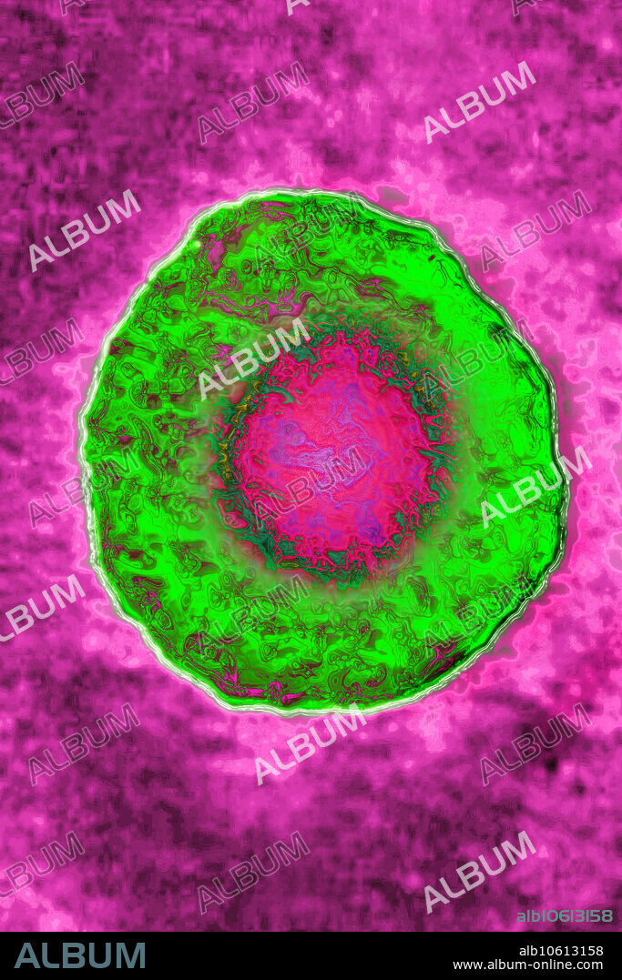 Herpes Simplex Virus 4 (HSV4). The HSV4 or Epstein-Barr virus, is the infectious mononucleosis virus. Image colorization of a Transmission Electron Micrograph view (TEM). Viral diameter approximately 200 nm.