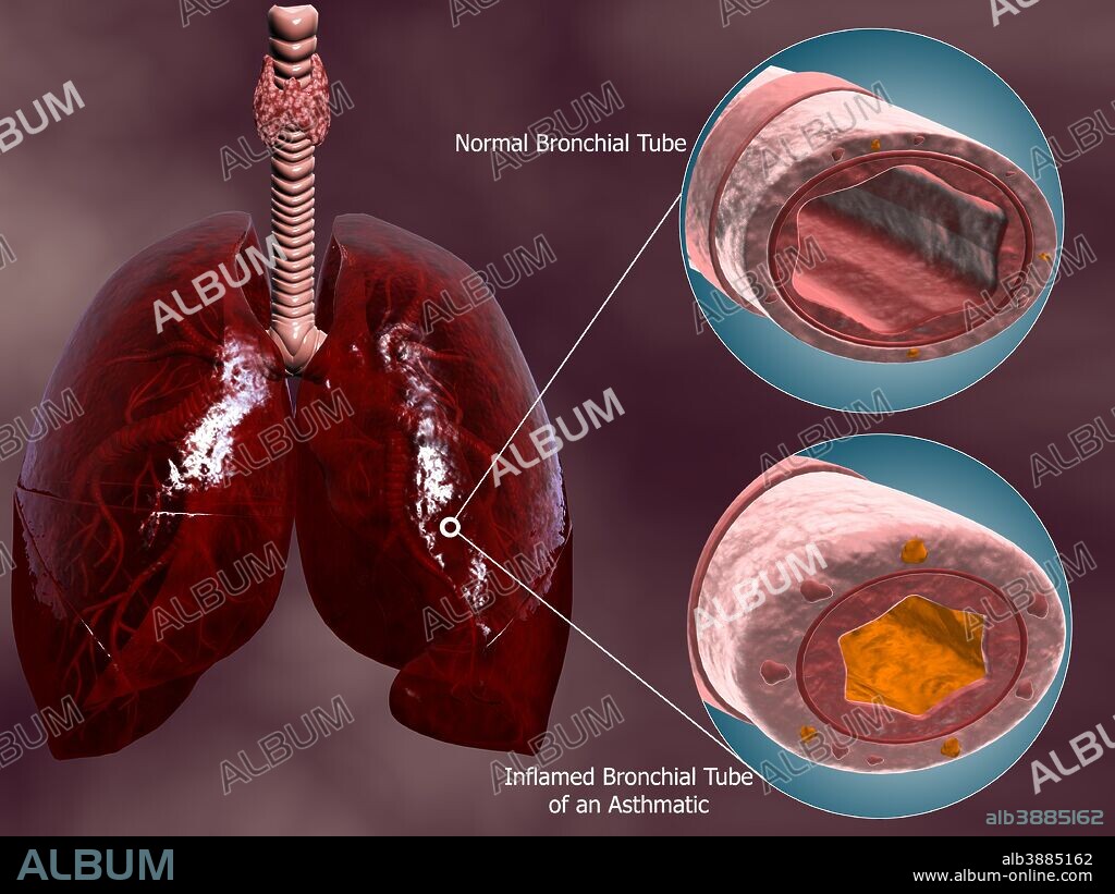 Trachea cross-section with lungs, showing comparison of normal and asthmatic bronchiole.