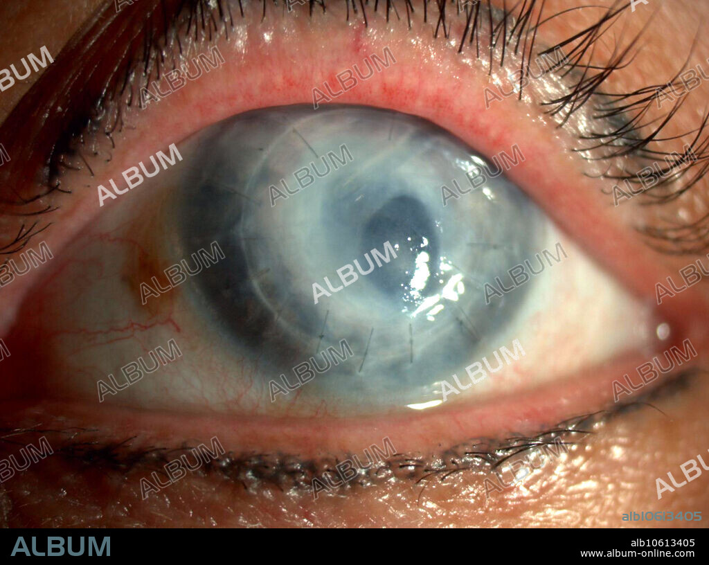 Failed corneal transplant.