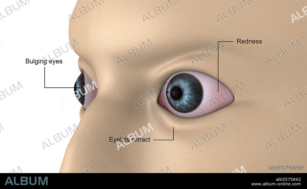 Medical illustration of exophthalmos, bulging of the eyes.