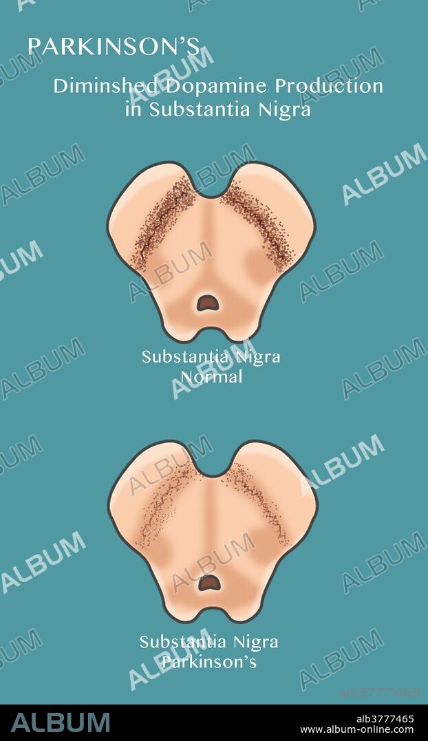 Illustration showing degeneration of dopaminergic neurons in the substantia nigra of the midbrain. At top is a normal substantia nigra at bottom is a diminished substantia nigra. Degeneration of this structure is characteristic of Parkinson's disease.
