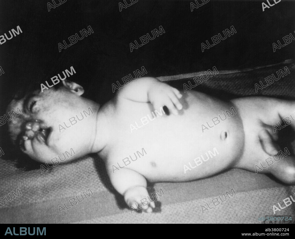 Editorial Use Only . Baby with birth defects resulting from Thalidomide.