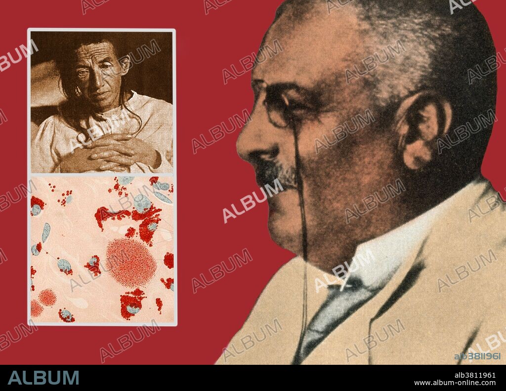 Alois Alzheimer (1864-1915). In 1906, German psychiatrist and neuropathologist Alois Alzheimer made a complete clinical and pathological description of presenile dementia, which came to be known as Alzheimer's disease, a progressive condition in which nerve cells in the brain degenerate. The inset photograph at top shows Auguste Deter (1850-1906), the first patient Alzheimer diagnosed with the disease. Below her is a micrograph from a 1911 Journal of Psychiatry and Neurology (Zeitschrift fÃ¼r die Gesamte Neurologie und Psychiatrie) showing neurofibrillary tangles in the brain nerve cells of a patient afflicted with the disease.
